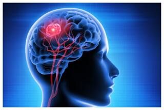 क्या दिमाग में भी हो सकता है कैंसर? जानें क्या कहते हैं डॉक्टर