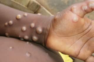 1st Suspected Case Of Monkeypox Reported In India