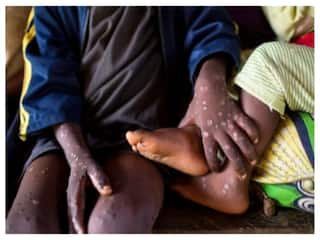 केरल के मलप्पुरम में मिला Mpox का संदिग्ध मरीज, जांच के लिए भेजा गया सैंपल
