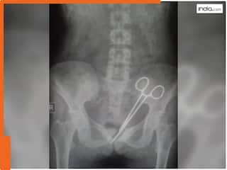 डॉक्टरों की लापरवाही, पेट में 12 साल तक पड़ी रही कैंची; जानिए कैसे चला पता