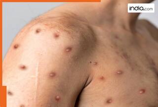 First case of clade I mpox detected in American state of…..., patient had travelled from…...