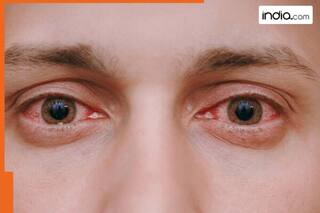 Urgent warning issued to UK, Africa travellers as 'deadliest' Bleeding Eye Virus triggers global fear, learn about symptoms, precautions, treatment, etc.