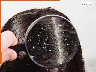 Dandruff कर रहा है शर्मिंदा? काम आएगा कपूर का ये एक छोटा सा नुस्खा