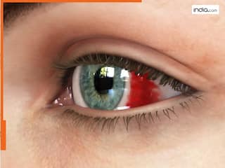 क्या है Bleeding Eye Virus? जिससे आठ दिन में हो जाती है व्यक्ति की मौत