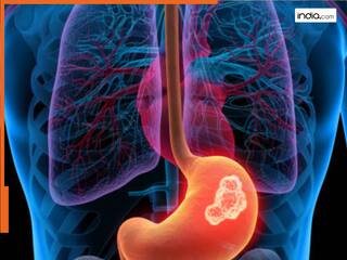 पुरुषों में पेट के कैंसर का जोखिम दोगुना, ये कारण हो सकते हैं जिम्मेदार