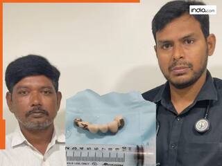 सोते समय शख्स ने निगल लिए नकली दांत, डॉक्टरों को करनी पड़ गई फेफड़े की सर्जरी