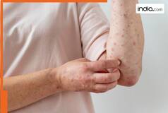 After HMPV, new Mpox strain detected: Symptoms to prevention, all you need to know