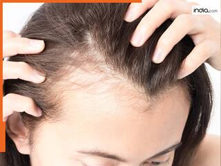 क्या आप हो रहे गंजेपन का शिकार? शरीर में हो सकती है इन 3 चीजों की भारी कमी