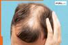 Revealed: Rapid hair loss cases in people of Maharashtra's Buldhana due to....