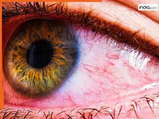 क्‍या आंखों को नुकसान पहुंचाता है HMPV वायरस? डॉक्‍टर से जानें इसके लक्षण और बचाव के उपाय