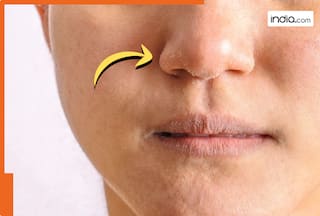 क्या नाक के आस-पास जम जाती है ऐसी सूखी पपड़ी? तो हो सकता है स्किन इंफेक्शन! तुरंत कराएं जांच