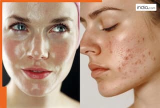 गर्मियों में स्किन क्यों हो जाती है ऑयली? किस तरह पाएं इस पर कंट्रोल