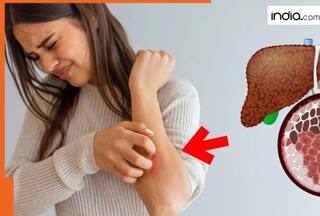 Fatty liver disease: Common signs and symptoms you must not ignore