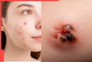 हर पिंपल को न करें नजरअंदाज! स्किन कैंसर का हो सकता है खतरा, हो जाएं सतर्क!