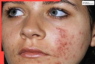 बारिश में किस कारण से हो जाते हैं पिंपल्स? 99% लोग नहीं जानते होंगे सही जवाब