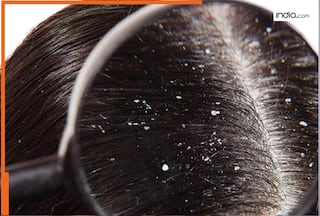 रूसी हटाने के लिए न करें खर्च, घर पर ही नेचुरल तरीके से मिनटों में इससे पाएं छुटकारा