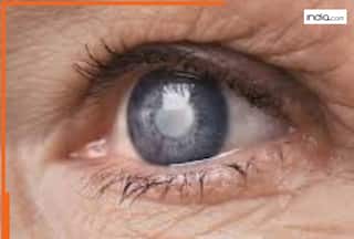 क्या बिना ऑपरेशन ठीक हो सकता है मोतियाबिंद? डॉक्टर ने बताया सच