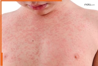 क्या आप भी सोचते हैं खसरा सिर्फ बच्चों को होता है? डॉक्टर्स से जानिए सच्चाई