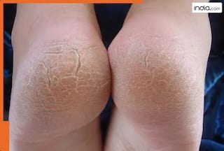 फटी एड़ियों के लिए रामबाण हैं ये 5 घरेलू नुस्खे...एक भी उपाय इस्तेमाल करने पर मिलेगा तुरंत आराम