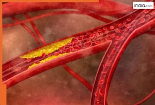 शरीर के किस भाग में जमा होता है सबसे ज्यादा कोलेस्ट्रॉल....हार्ट अटैक के साथ होता है इन 5 बीमारियों का खतरा