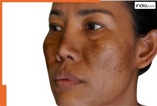 सालों पुरानी झाइयों को हटाने के लिए बड़ा फायदेमंद है ये घरेलू नुस्खा....हफ्तेभर में दिखने लगेगा फर्क