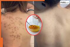 फोड़े-फुंसियों पर लगाएं ये चमत्कारी पेस्ट! 10 मिनट में साफ होगी त्वचा...किचन में पड़ी इन 2 चीजों से बनाएं ये जादुई घरेलू नुस्खा