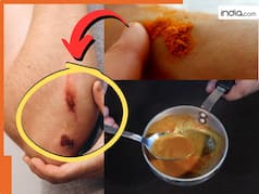 घाव पर 'हल्दी-तेल' का लेप लगाना, फायदेमंद या नुकसानदायक? जानिए क्या कहता है मेडिकल साइंस