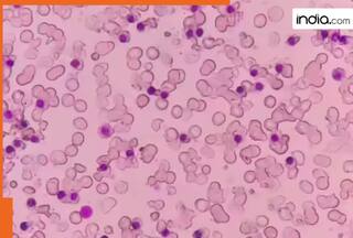 What is Alpha Thalassemia? Types, symptoms, and diagnosis