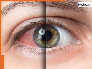 लगातार आंखों से निकलता है पानी? अपनाएं कुछ जरूरी टिप्स! परेशानी से मिलेगा तुरंत छुटकारा