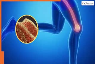 क्या होता है Bone Marrow Cancer? जानें लक्षण, कारण और इलाज की पूरी जानकारी
