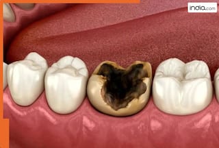 सिर्फ मीठा खाने से नहीं, बल्कि इन 5 खास वजहों से भी दांतों में लगती है Cavity!
