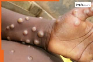 New variant of monkeypox detected in Netherlands; WHO taking it 'seriously'