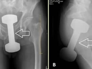 शख्स के पेट से निकला 2.5KG का डंबल, डॉक्टर ने पूछा कैसे खाया, होश उड़ा देगा मरीज का जवाब