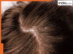 तेल में मिलाकर लगा लें इस एक चीज का रस, सर्दियों में बिल्कुल नहीं होगा डैंड्रफ- बाल भी होंगे मजबूत