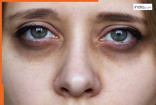 महंगी क्रीम नहीं, घर की रसोई से पाएं डार्क सर्कल्स से छुटकारा, आजमाकर देखें ये 5 असरदार नुस्खे