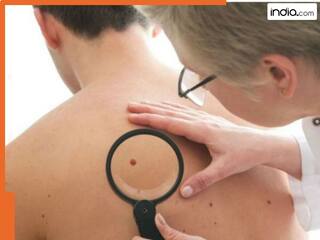 ये 5 रोजमर्रा की आदतें बढ़ा सकती हैं स्किन कैंसर का खतरा! इग्नोर करने पर पड़ सकते हैं लेने के देने