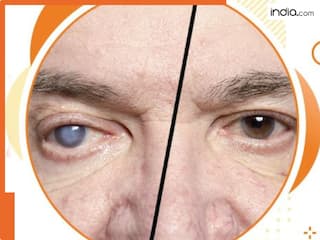 इस 5 तरीकों से पहचानें मोतियाबिंद होने के शुरुआती लक्षण! समय पर ध्यान ना देने पर हो सकते हैं अंधे