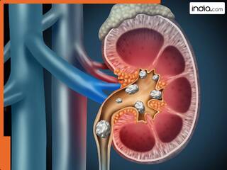 पथरी मरीजों के लिए काल के समान हैं ये फल, भूलकर भी न करें इनका सेवन