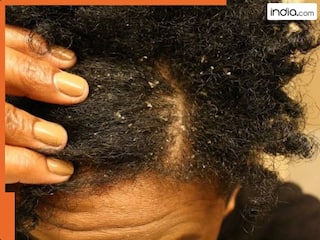 सर्दियों में बालों का डैंड्रफ खत्म करने के लिए अपनाएं ये 5 आसान तरीके! हेल्दी रहने लगेगा स्कैल्प