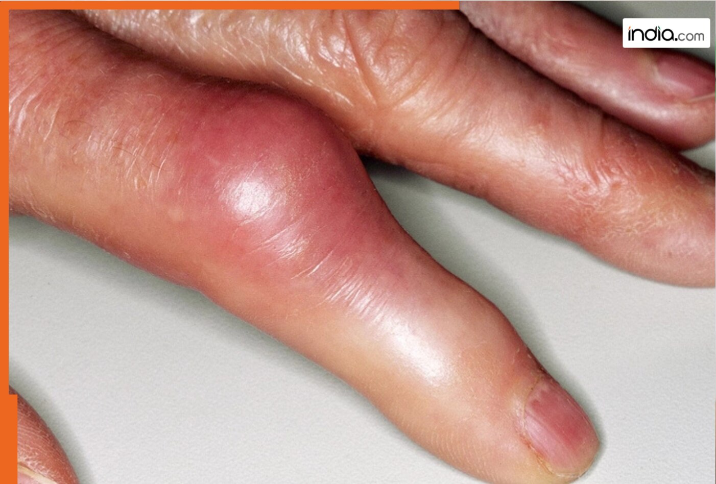 सर्दी में हाथ-पैर की उंगलियां क्यों सूज जाती हैं? डॉक्टर्स ने बताए छिपे कारण और घरेलू उपाय जो राहत देंगे तुरंत