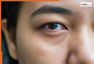 आंखों में दिख रहे हैं ये लक्षण तो समझ लीजिए किडनी हो रही है खराब! समय से जान लेंगे लक्षण तो बच जाएगी जान