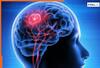 दिमाग को चुपके से खोखला कर सकती है विटामिन B12 की कमी, ये लक्षण दिखें तो तुंरत अस्पताल भागें!