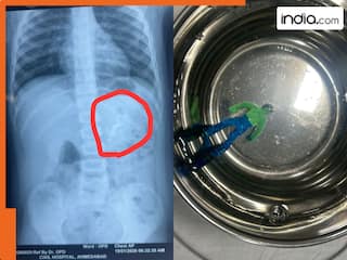 खेल-खेल में चली जाती मासूम की जिंदगी! सालभर के बच्चे ने निगल लिया Hulk, डॉक्टरों ने ऐसे बचाई जान