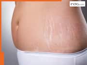 वजन कम करने पर क्यों पड़ जाते हैं स्ट्रेच मार्क्स? जानें घरेलू उपाय और कैसे करें बचाव