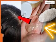 क्या वाकई शैंपू में चीनी मिलाकर लगाने से Dandruff खत्म हो जाता है? सोशल मीडिया पर वायरल हो रहा है नुस्खा