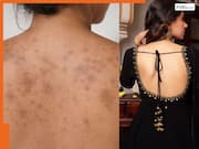 काली पीठ की वजह से नहीं पहन पा रही हैं बैकलेस टॉप? डार्कनेस को दूर करने के लिए हल्दी में मिलाकर लगाएं ये 1 चीजें